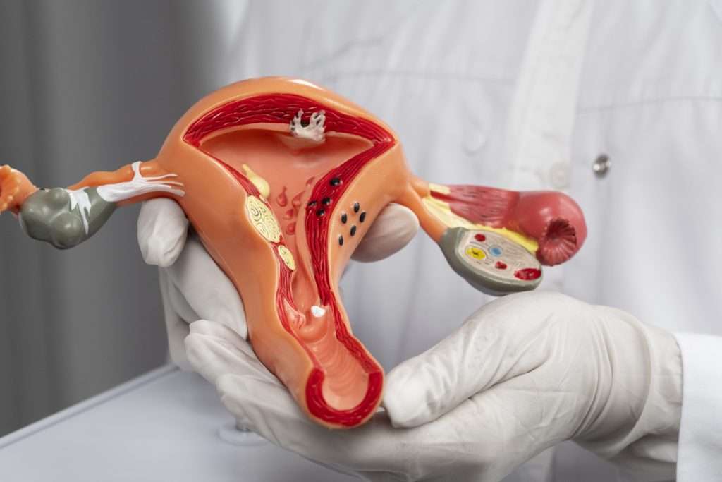 Cervicotrigonitis: Inflamació del Trígon Vesical