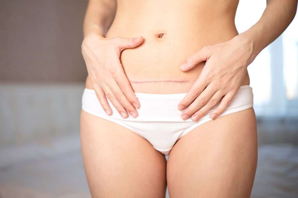 Dermapen: Nova tècnica per a millorar la pell de l'abdomen i les cicatrius de cesària